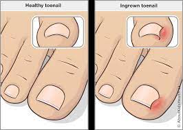 Ingrown toenails
